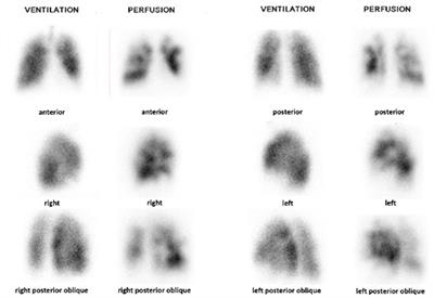 Lung Ventilation/Perfusion Scintigraphy for the Screening of Chronic Thromboembolic Pulmonary Hypertension (CTEPH): Which Criteria to Use?